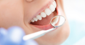 teeth-whitening filaments